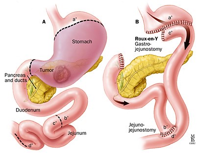 Schematische weergave van de maag bij een gedeeltelijke maagverwijdering
